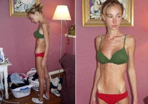 Suffering from severe anorexia, Hattie Boydle weighed just 26 kilograms. But she recovered and went on become a world champion fitness model and inspirational speaker.