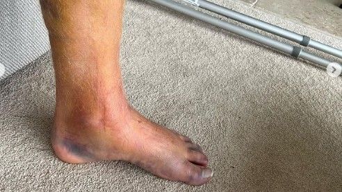 England star Jonny Bairstow shares gruesome photo of horrific broken leg