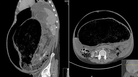 Doctors have described how a man was put in intensive care after his bowel burst, leeching faeces into his body. 