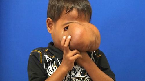 Surgeons remove huge growth covering boy's face