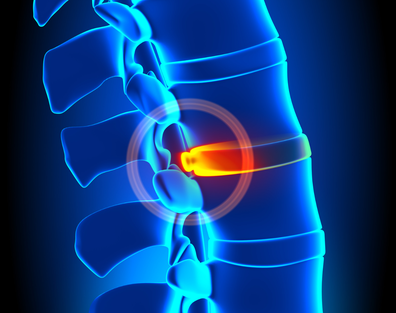 Bulging disc in the spine 