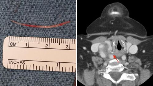 Elderly woman complaining of sore throat found to have 3cm fishbone in oesophagus