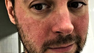The red splotches on Will&#x27;s face baffled doctors for years before a remarkable breakthrough moment.
