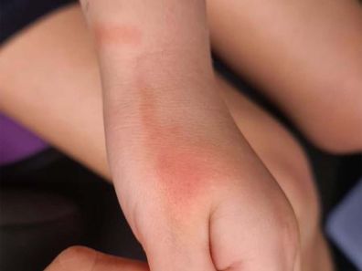 Tracking line on child's hand after mosquito bite.