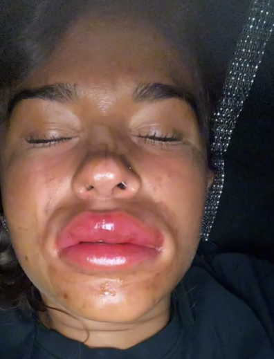 Woman's lip filling horror after night of drinking
