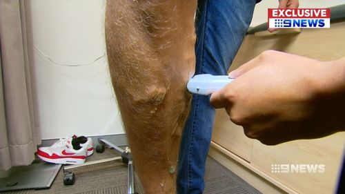 Varicose veins are the result of faulty valves within veins, causing the blood to pool. Picture: 9NEWS