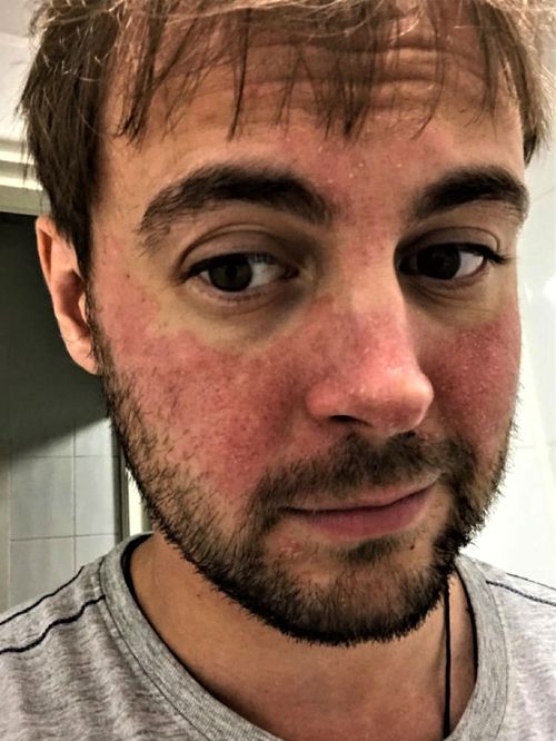 The red splotches on Will's face baffled doctors for years before a remarkable breakthrough moment.