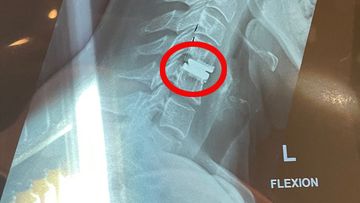 Tamara Watkins was suffering from extremely painful headaches, back pain and nausea before an MRI showed a bone spur was growing into her spine. This x-ray shows her spine after surgery.