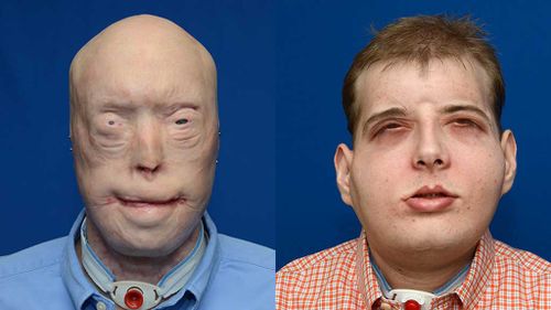 This combination photo provided by the NYU Langone Medical Center shows face transplant patient Patrick Hardison before (L) and after his surgery. (AFP)
