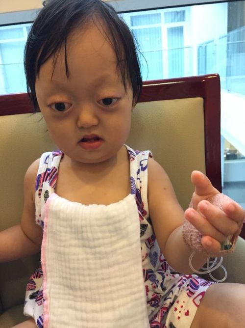 Lam suffers from Crouzon Syndrome, which affects the development of the skull. Picture: Supplied