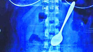<p>A 14cm spoon has been removed from a Chinese student's stomach after she accidentally swallowed the utensil.</p><p>
Zhang Weiwei, 22, was eating icecream while walking back to her room at a university in Wuhan last week when someone suddenly pushed her, causing the metal spoon to be pushed down her throat, local media reports.</p><p>
Ms Weiwei said she felt bloated but not unwell enough to seek immediate medical treatment.</p><p>
It was only after she researched possible outcomes online that she realised how serious the situation was.</p><p>
A bizarre X-ray capture showed the spoon, measuring 2cm at its widest, lodged in Ms Weiwei's stomach.</p><p>
Doctors took only 10 minutes to fish it out using a wire snare passed through the patient's mouth and into her oesophagus and stomach to fish it out.</p><p>
She reportedly escaped the ordeal with no internal bleeding.</p><p>
Last month, another Chinese woman was rushed to hospital after a 30 centimetre-long spatula became lodged in her throat.</p><p>
Strangely enough, they're not alone. Click through to see X-rays of objects in strange places.</p>

