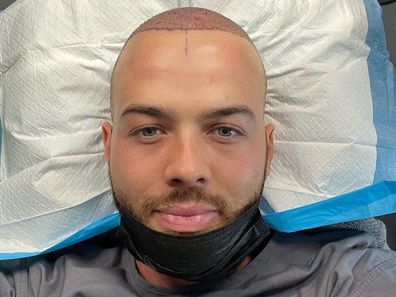 MAFS, Samuel Levi, hair transplant procedure