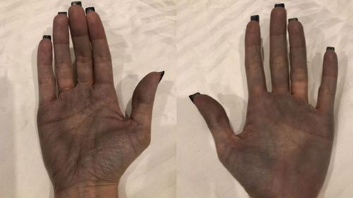 Shelly Rafferty's hands turned blue/black. It was just one of a range of symptoms her doctors could not explain. The unusual colour went away after she had her implants removed.