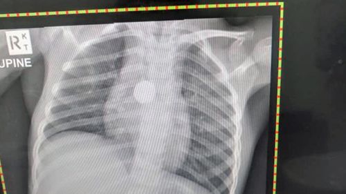 An X-Ray showed the button battery had been lodged in Shaylah's throat for six months.