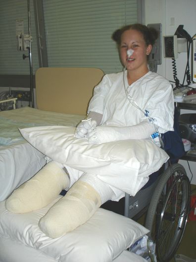 Mel Groenewold in hospital after losing her hands and feet.