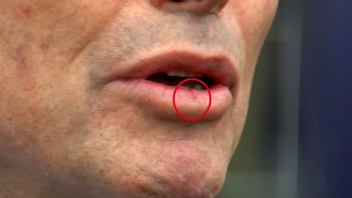 The incident has left Mr Abbott with a small cut on his lip.