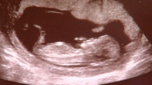Foetuses have different legal statuses around Australia.