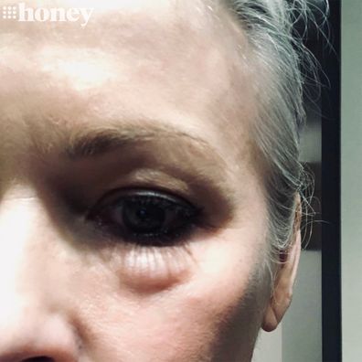 Sami Lukis' under-eye lumps years after dermal filler