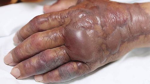 The man's hand and arm were swollen by the time he reached the ER.