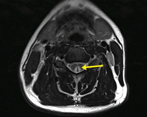 The inverted "V" sign as shown in this medical scan is evidence of spinal damage through nitrous oxide use.