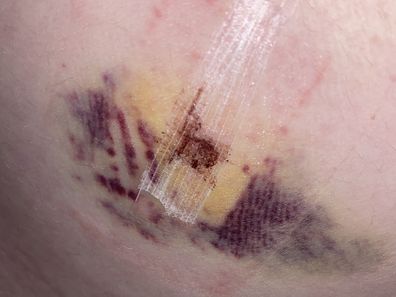 A shocking bruise after Caitlin Tiernan's endometriosis surgery.