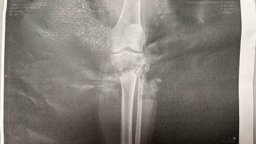 An X-ray shows the broken bone in Bridget Quartermain's leg.