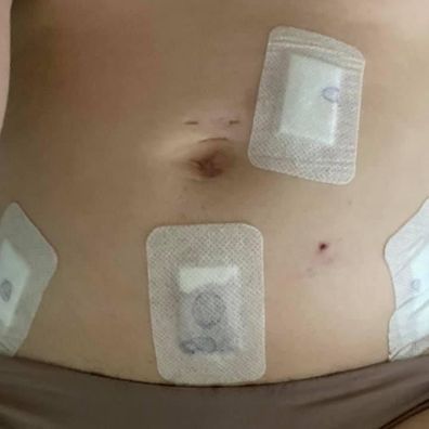 Rebecca Board's stomach after endometriosis surgery.