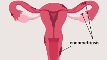Federal government commits funding to endometriosis and fertility research.