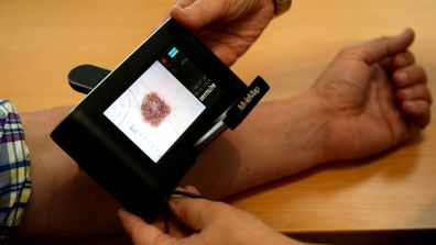 A patient has their skin checked for melanoma. (AAP stock)