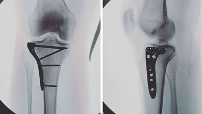Leila McKinnon hospital knee injury