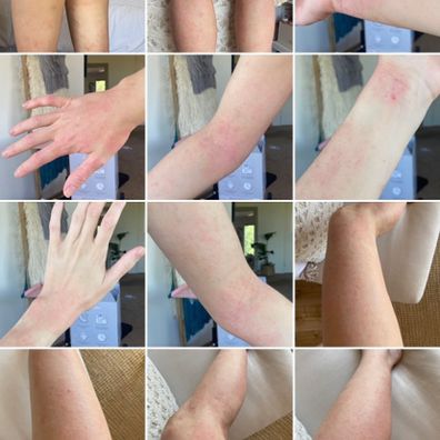 Maddie Edwards shares a photo of the eczema that covers 80 to 90 per cent of her body.