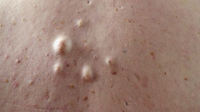 Bad Skin Clinic, 9Now