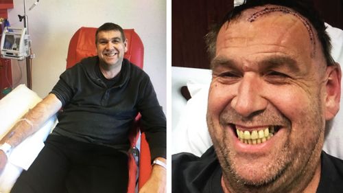 Steve Solomon pictured before and after his initial brain surgery to remove a tennis-ball sized tumour.