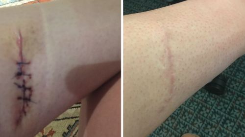 Georgia's scar three days after surgery (left) and one year later (right). (Image courtesy of Mary Davison)