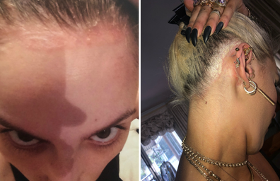 She began losing her hair in 2015 and wears hair extensions as a result.