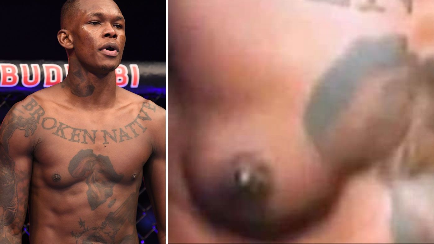 Israel Adesanya&#x27;s misshapen chest caused concern at UFC 253.