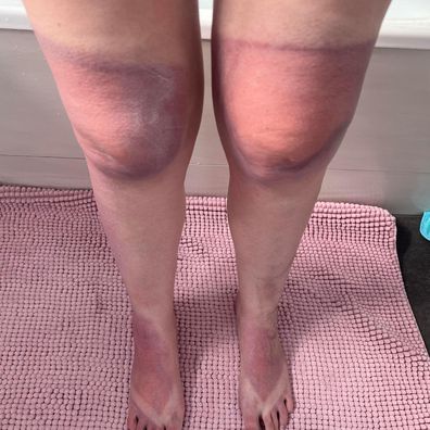 Pregnant woman Kara Lorraine shares photos of horrific sunburn after just 30 minutes in hot sun.