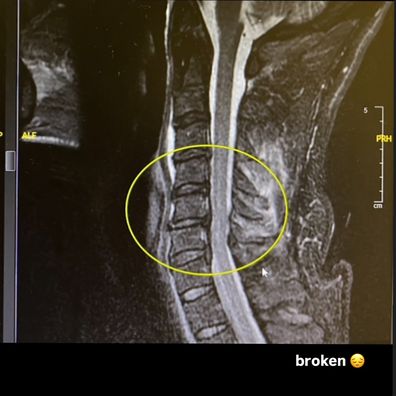 Nev Schulman reveals he broke his neck