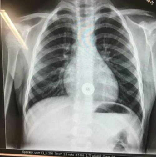 An x-ray showed the circular disc in the boy's stomach. (Facebook)