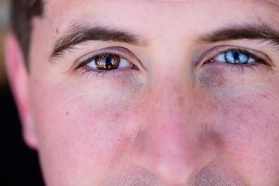 Man with heterochromia. Man with different coloured eyes.