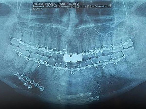 X-ray reveals Tupou's horrific injuries