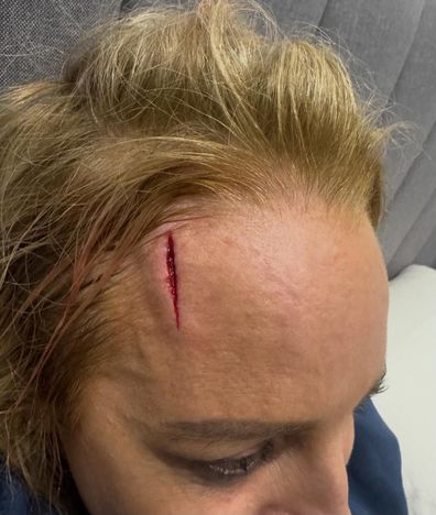 Carrie Bickmore smashed her head and has to undergo surgery after walking into a wall