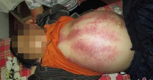 Images fom Mr Xiao's website reveal the extensive bruisingstemming from the slapping therapy. (Supplied)
