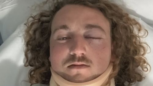The alleged fight left 22-year-old Will Salter with a severely damaged eye socket.