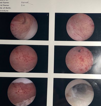 Every red spots and line in these photos show adenomyosis in the muscle of Erin Barnett's uterus. 
