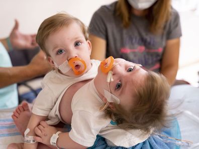 Michigan conjoined twins separated