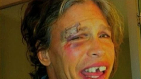 Steve Tyler performed on stage the day after doing this to his face