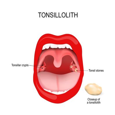 Tonsil stone