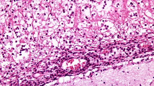 O alerta surge no momento em que os casos anuais de meningococo ultrapassam os 100 a nível nacional.