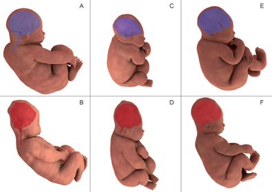 Foetal head moulding